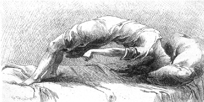 The-circular-arc-arc-de-cercle-Paul-Richer-Etudes-cliniques-sur-lhystero-epilepsie